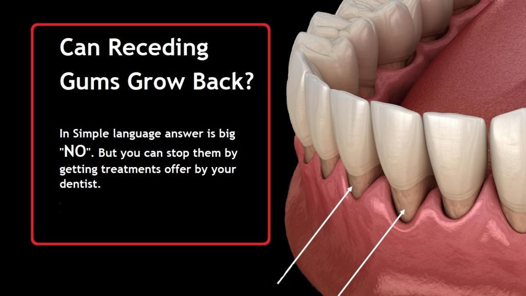 How Long Does It Take Gum Grafting To Heal - Dentist Diary